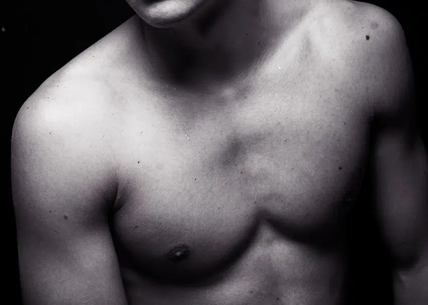 Dr Colson - Gynecomastie illustration