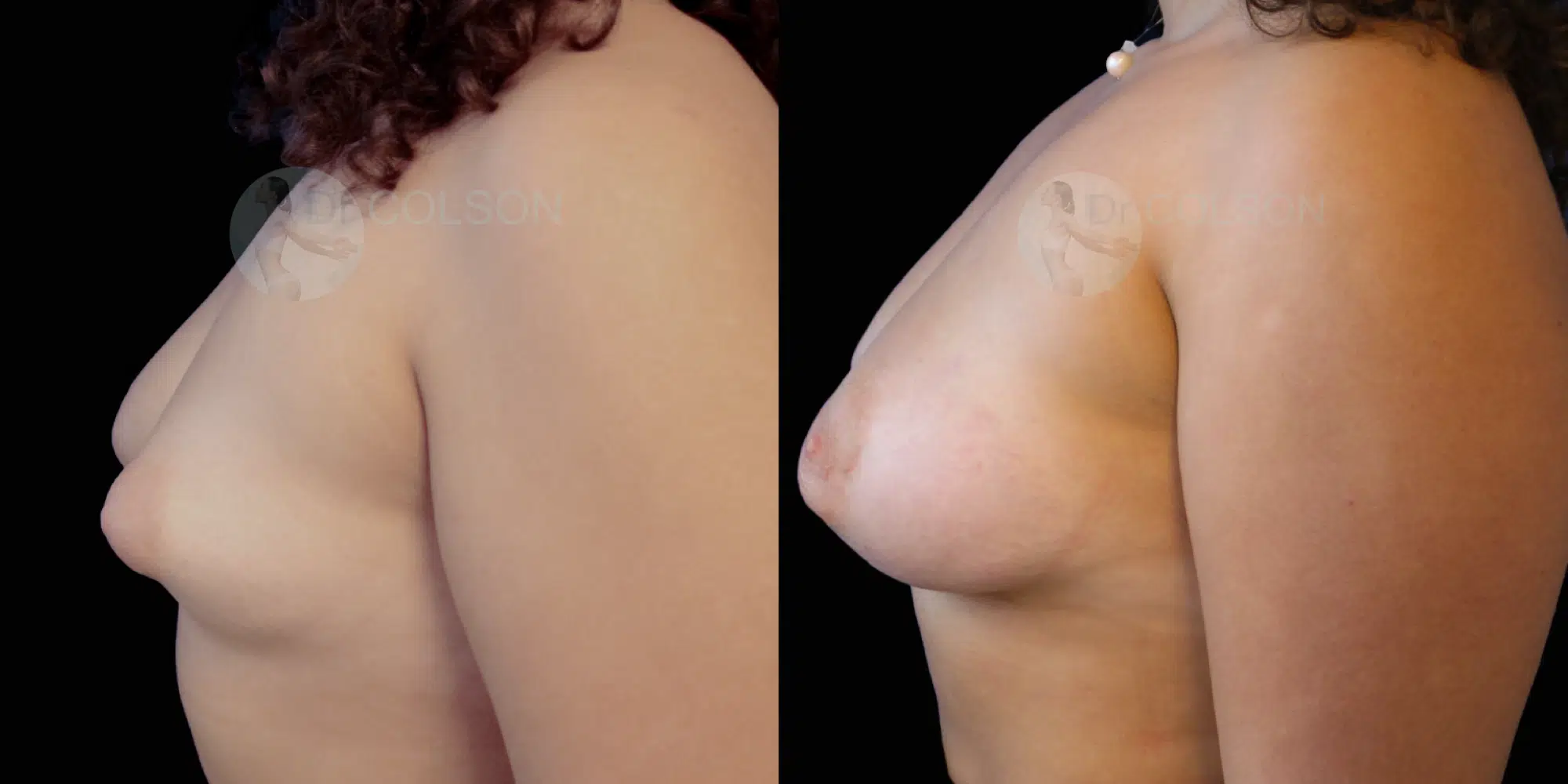 Dr Colson - Chirurgie sein - Asymetrie Profil