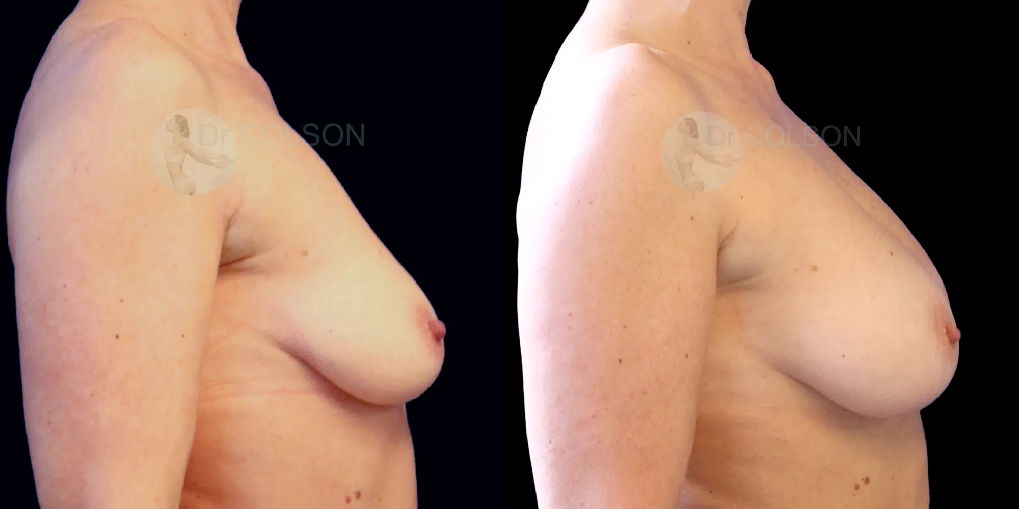 Dr Colson - Chirurgie sein - Lipofilling Mammaire Profil