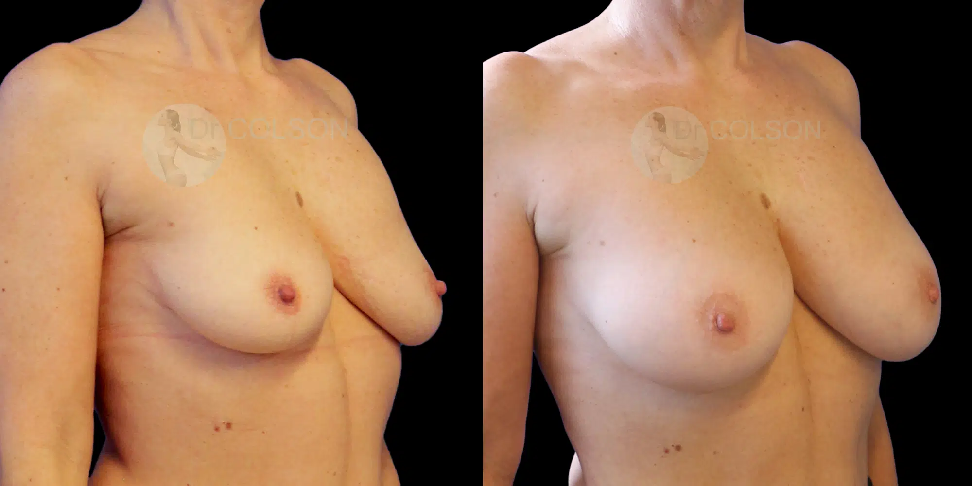Dr Colson - Chirurgie sein - Lipofilling Mammaire Trois Quart