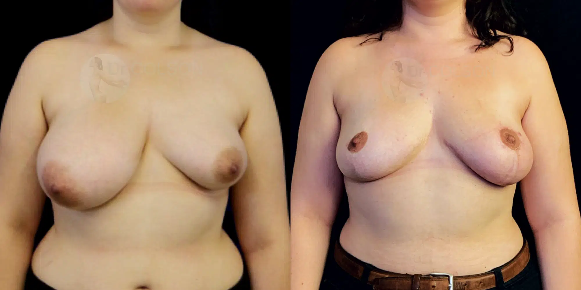 Dr Colson - Chirurgie sein - Asymetrie Face