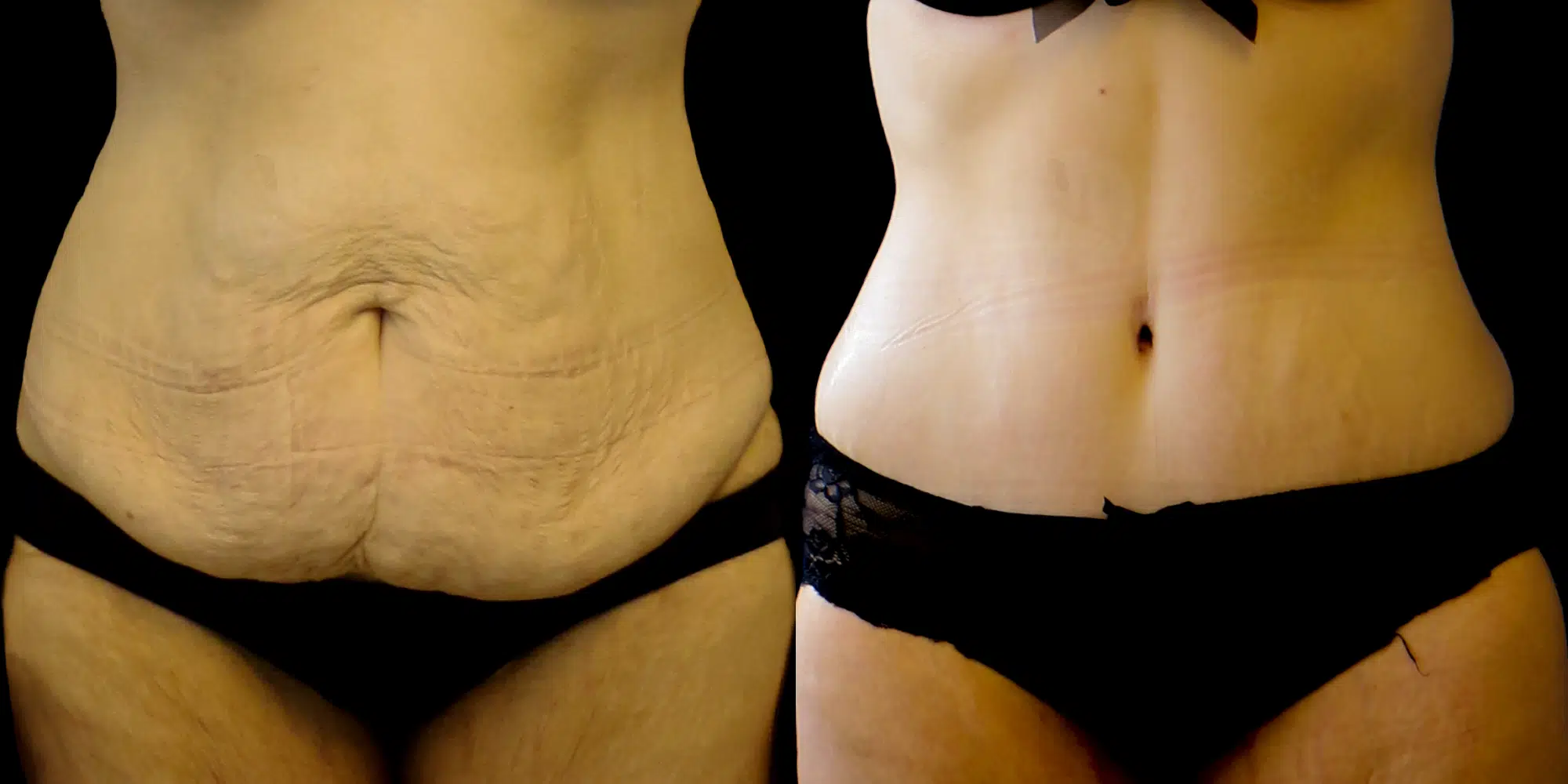 Abdominoplastie Face