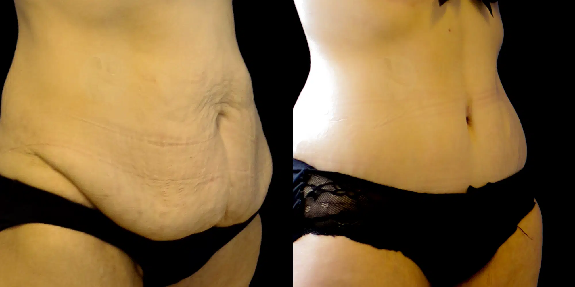Dr Colson - Chirurgie silhouette - Abdominoplastie Trois Quart