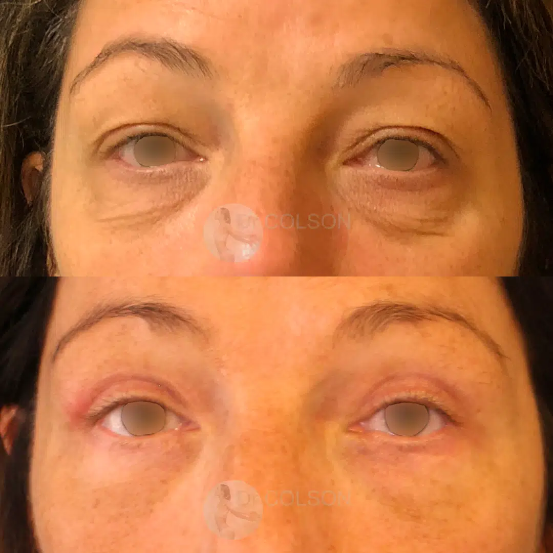 Blepharoplastie Superieure Inferieure Face