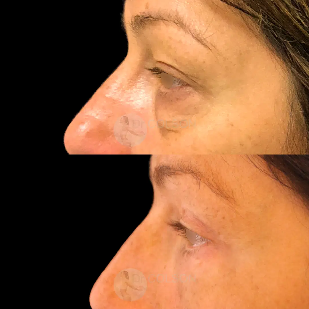 Dr Colson - Chirurgie visage - Blepharoplastie Superieure Inferieure Profil