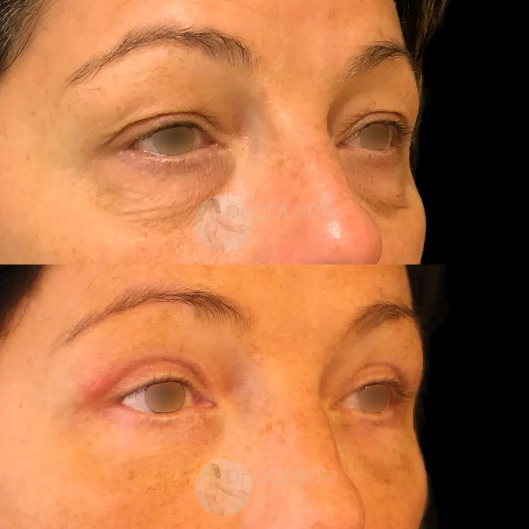 Dr Colson - Chirurgie visage - Blepharoplastie Superieure Inferieure Trois Quart