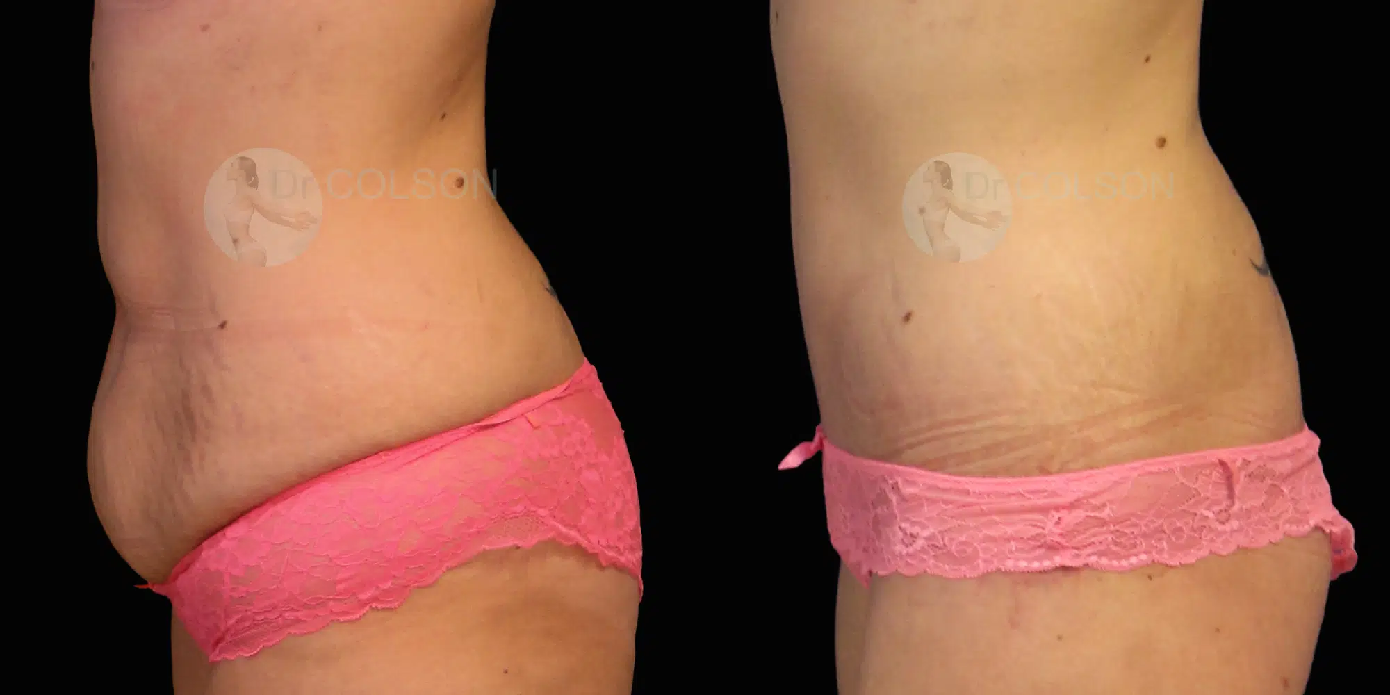 Dr Colson - Chirurgie silhouette - Bodylift Inferieur Profil