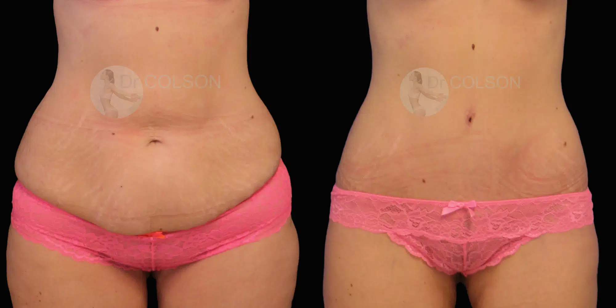 Dr Colson - Chirurgie silhouette - Bodylift Inférieur Trois Quart