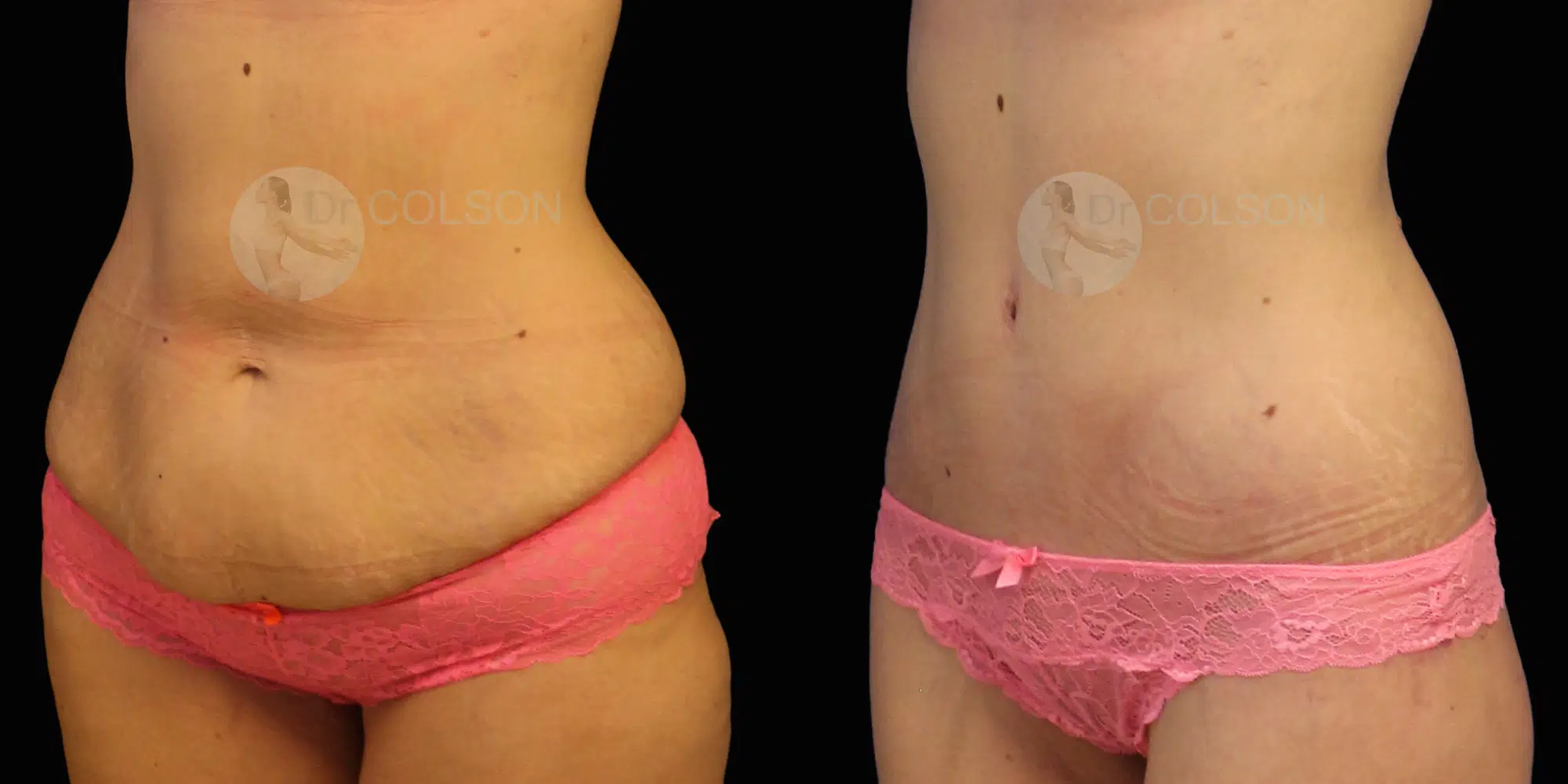 Dr Colson - Chirurgie silhouette - Bodylift Inferieur Trois Quart