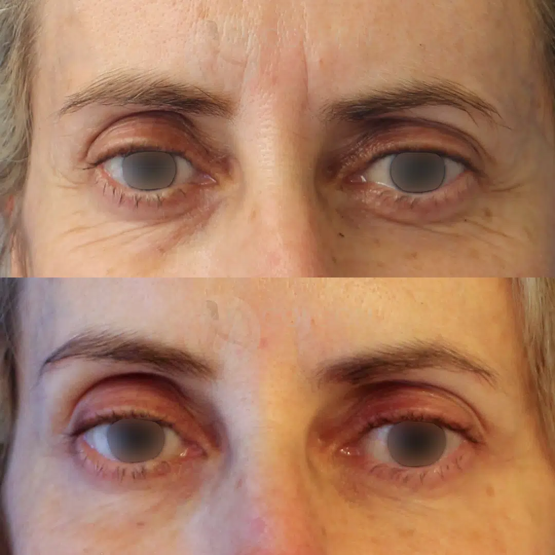 Dr Colson - Toxine botulique - Botox Face