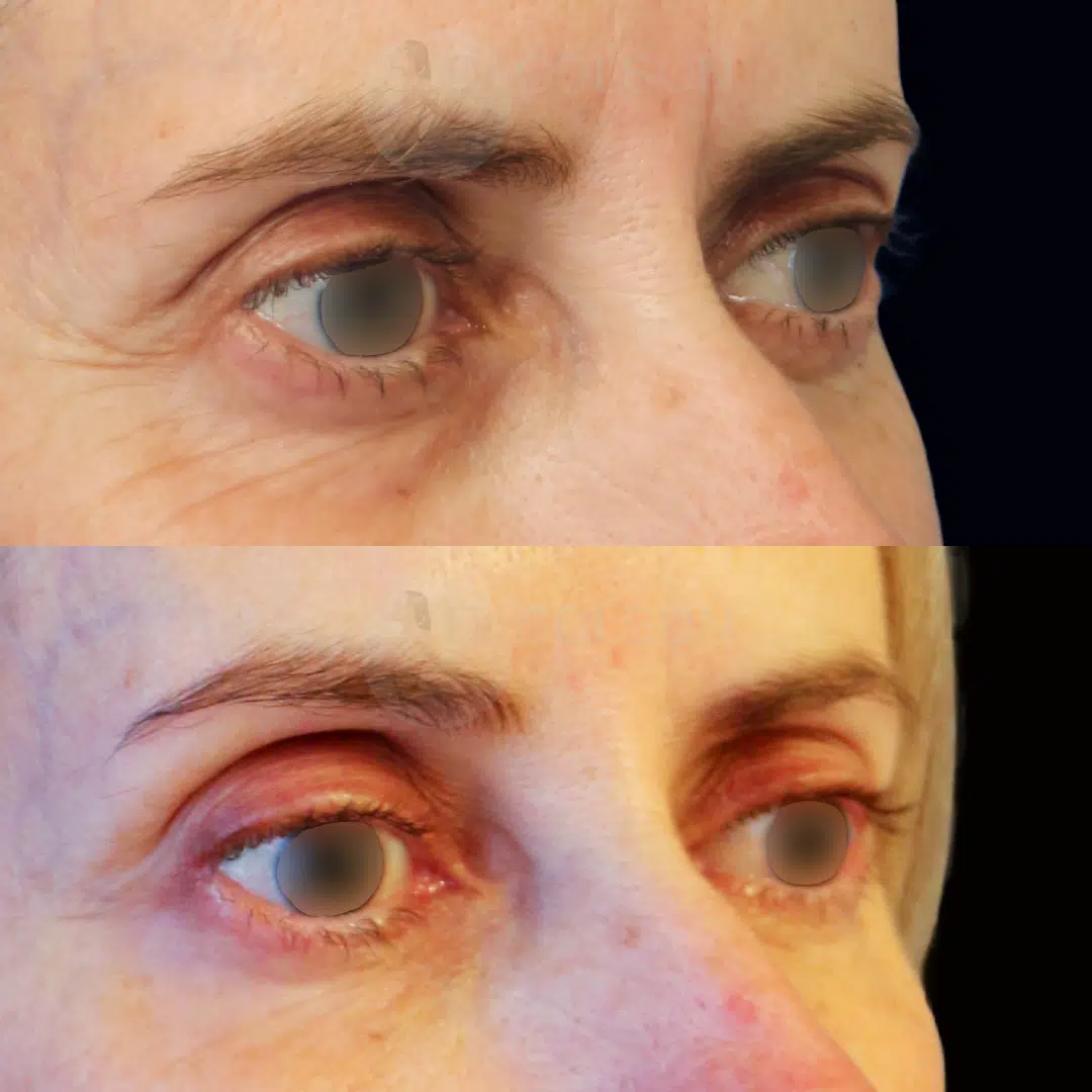 Dr Colson - Toxine botulique - Botox Trois Quart