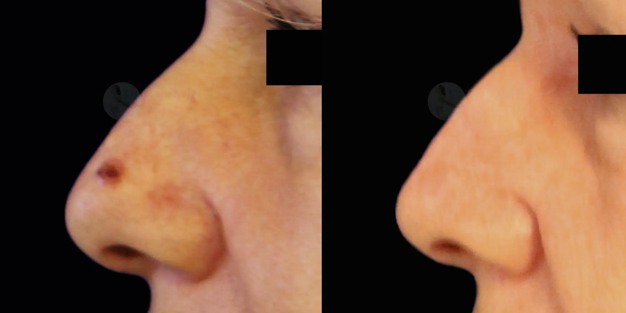 Dr Colson - Chirurgie peau - Tumeur cutanee Profil