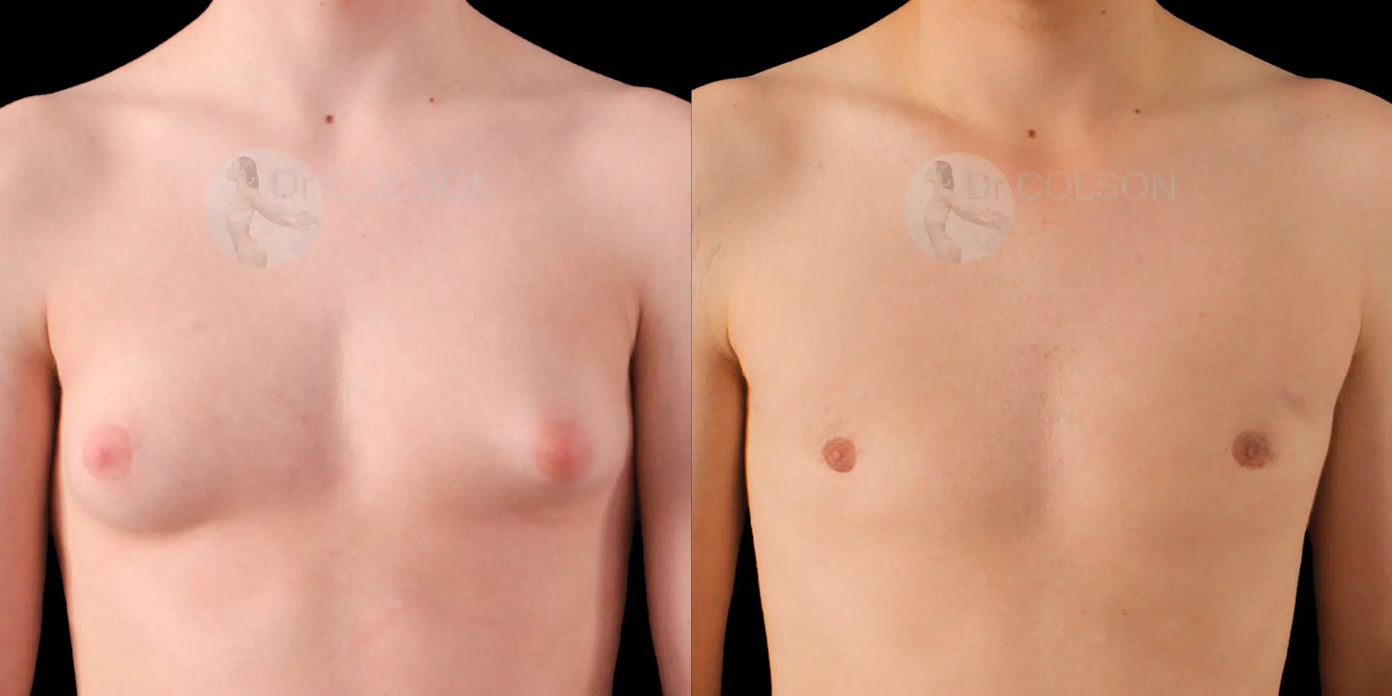 Dr Colson - Chirurgie homme - Gynecomastie Face