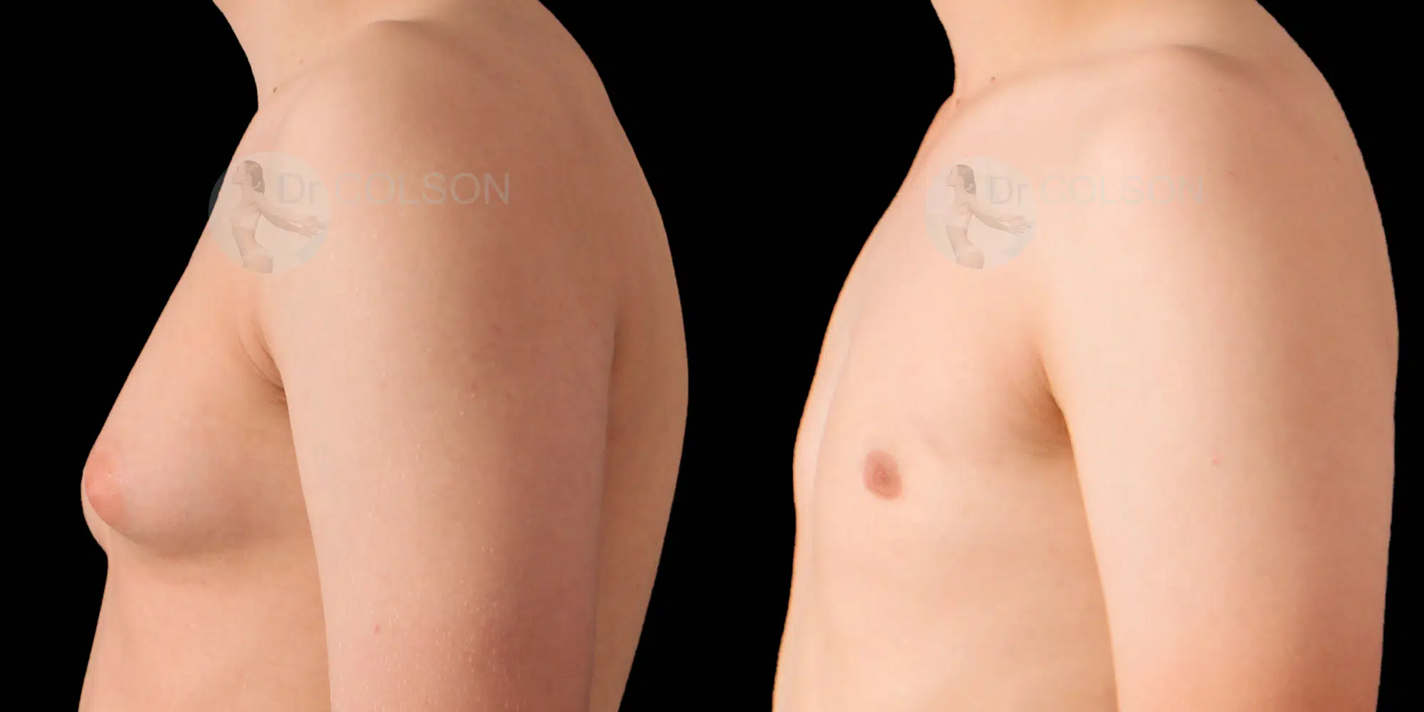 Dr Colson - Chirurgie homme - Gynecomastie Profil