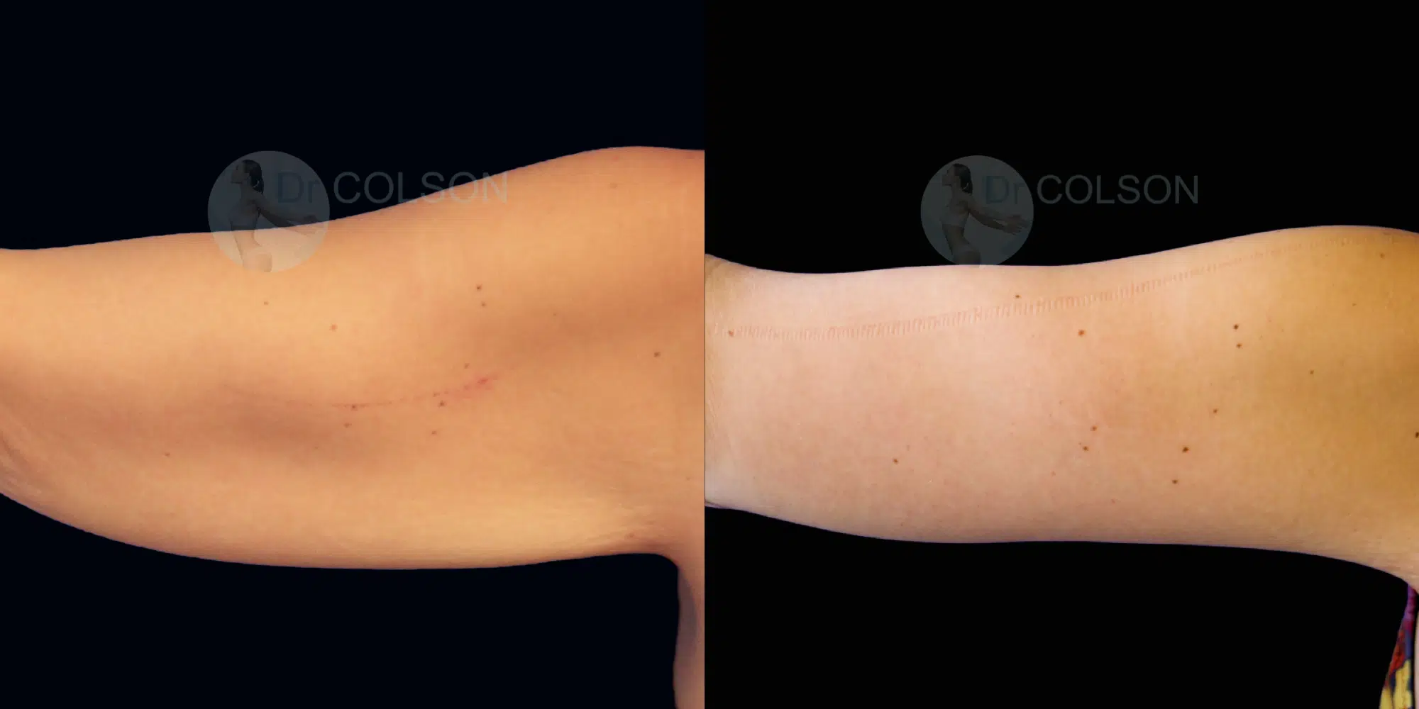 Dr Colson - Chirurgie silhouette - Lifting Bras Vue de Dos
