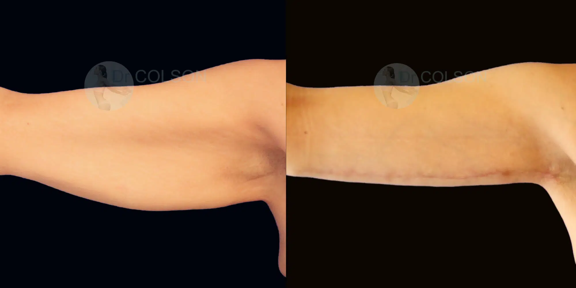 Dr Colson - Chirurgie silhouette - Lifting Bras Vue de Face
