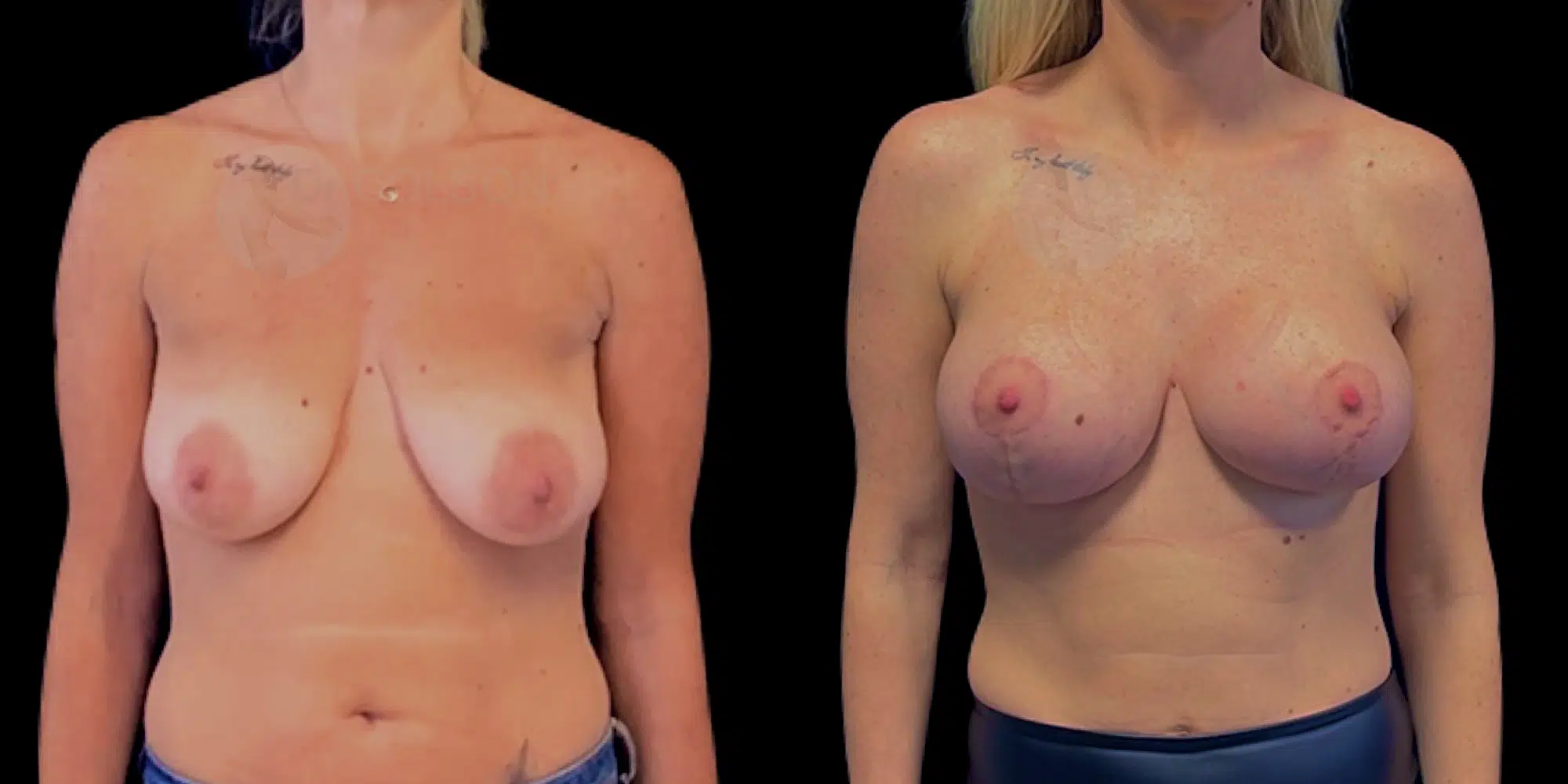 Dr Colson - Chirurgie sein - Lifting Mammaire Prothèse Face