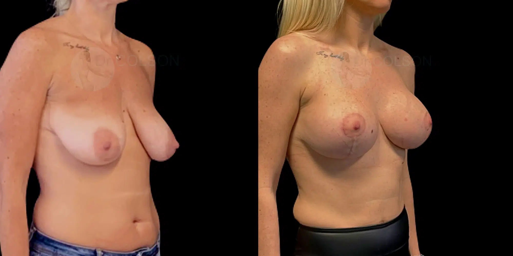Dr Colson - Chirurgie sein - Lifting Mammaire Prothese Trois Quart