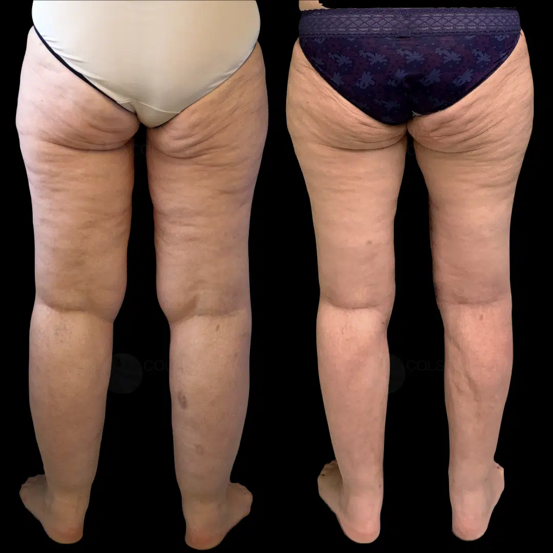 Dr Colson - Chirurgie silhouette - Lifting de Cuisse Vue de Dos