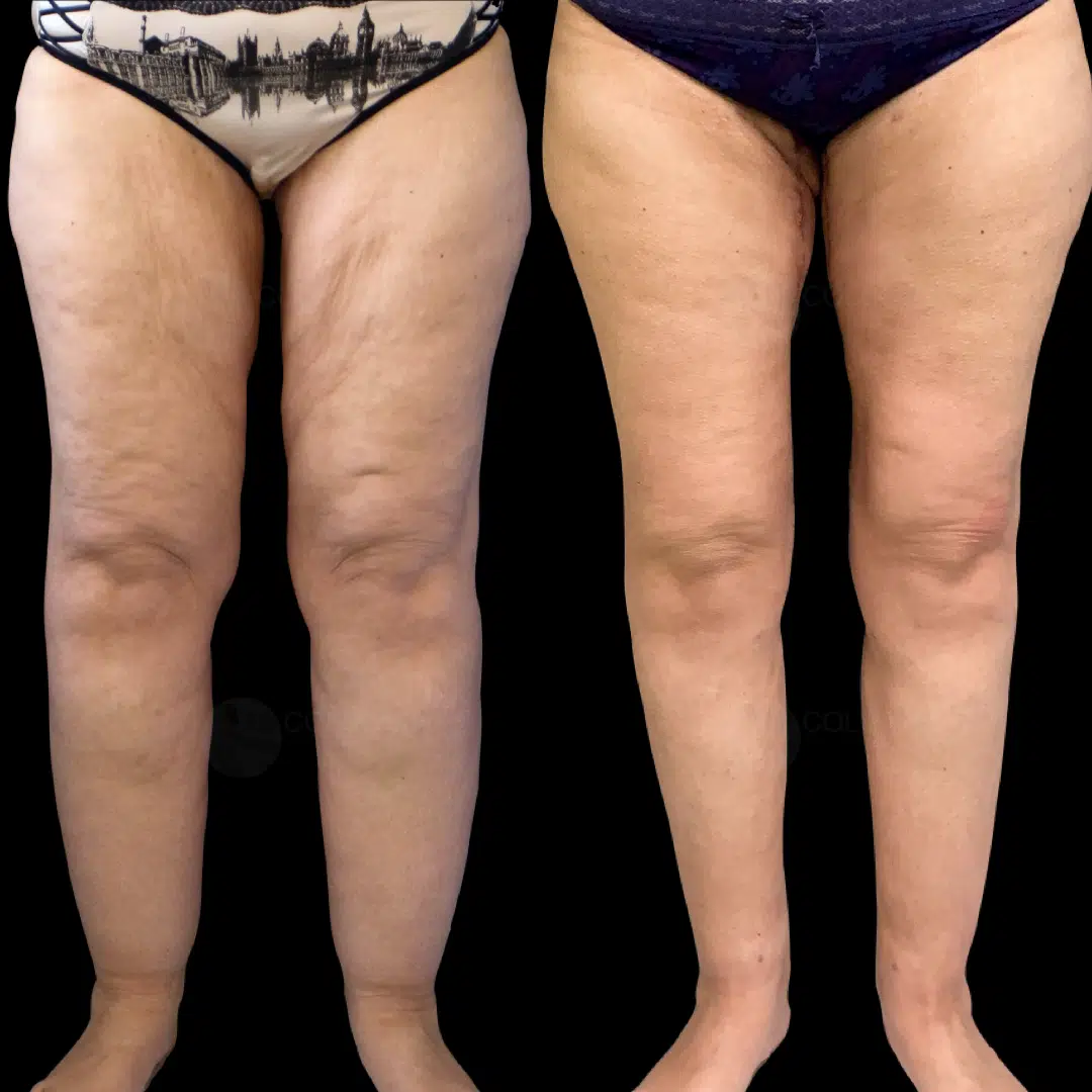 Dr Colson - Chirurgie silhouette - Lifting de Cuisse Vue de Face