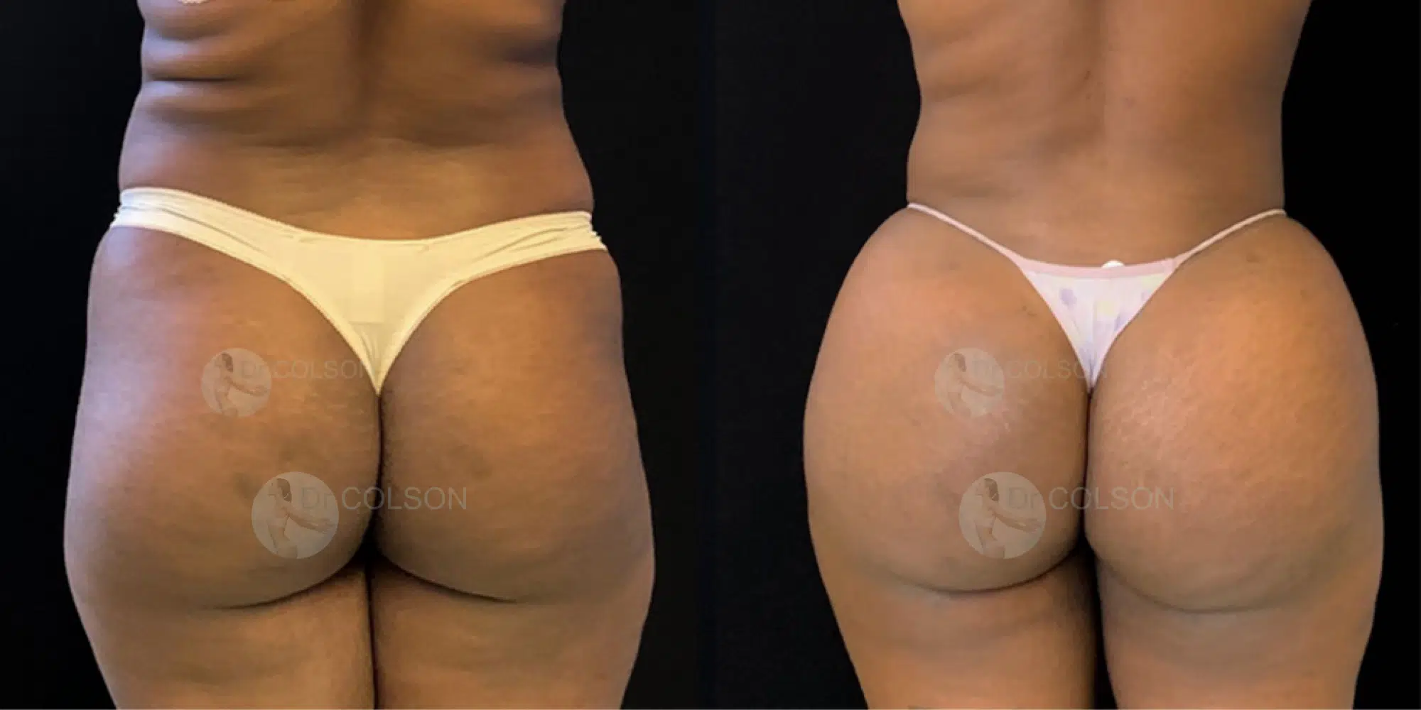 Dr Colson - Chirurgie silhouette - Lipofilling Fesses BBL Dos