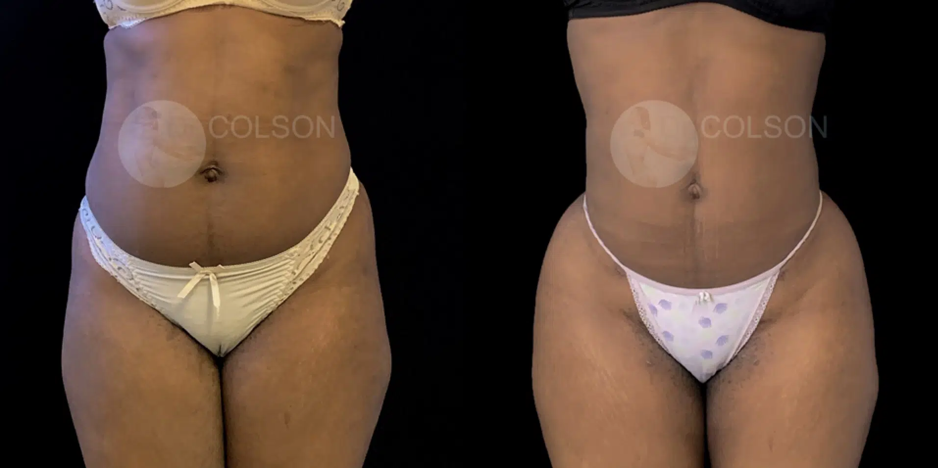 Dr Colson - Chirurgie silhouette - Lipofilling Fesses BBL Face