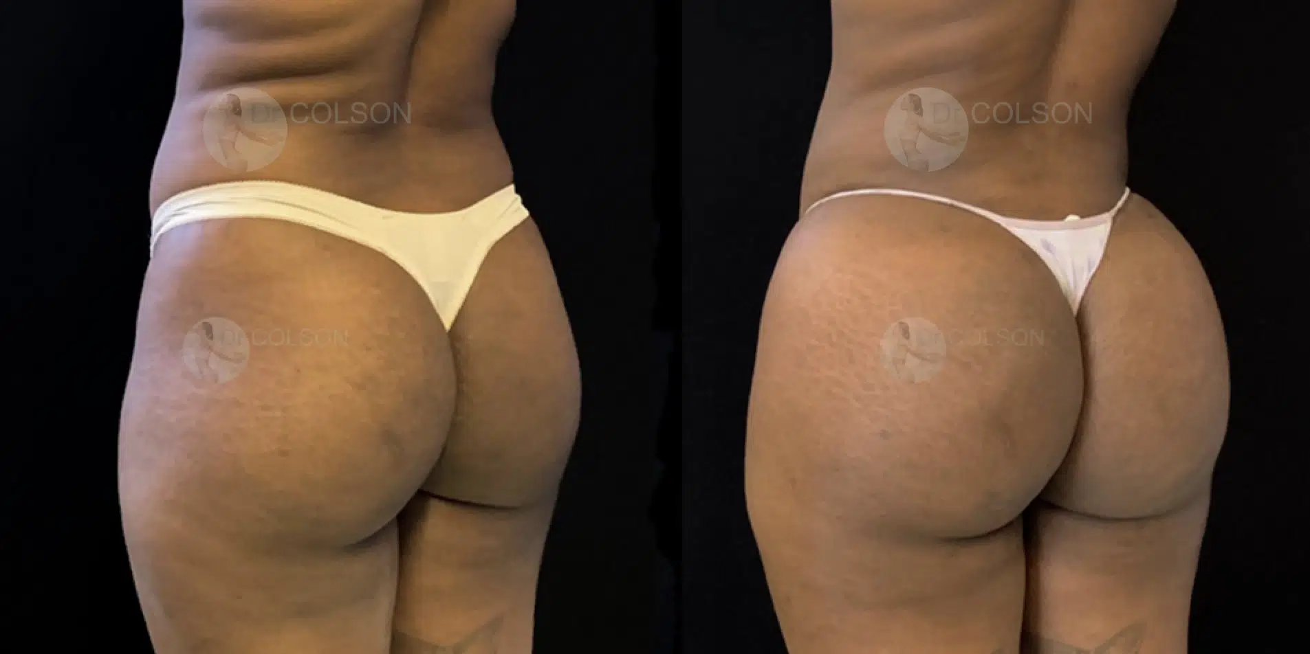 Dr Colson - Chirurgie silhouette - Lipofilling Fesses BBL Trois Quart Dos
