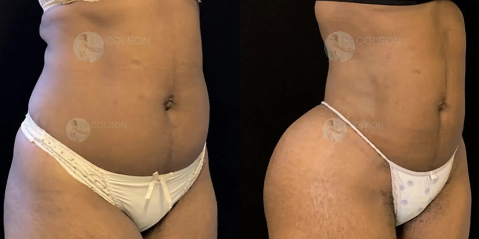 Dr Colson - Chirurgie silhouette - Lipofilling Fesses BBL Trois Quart Face