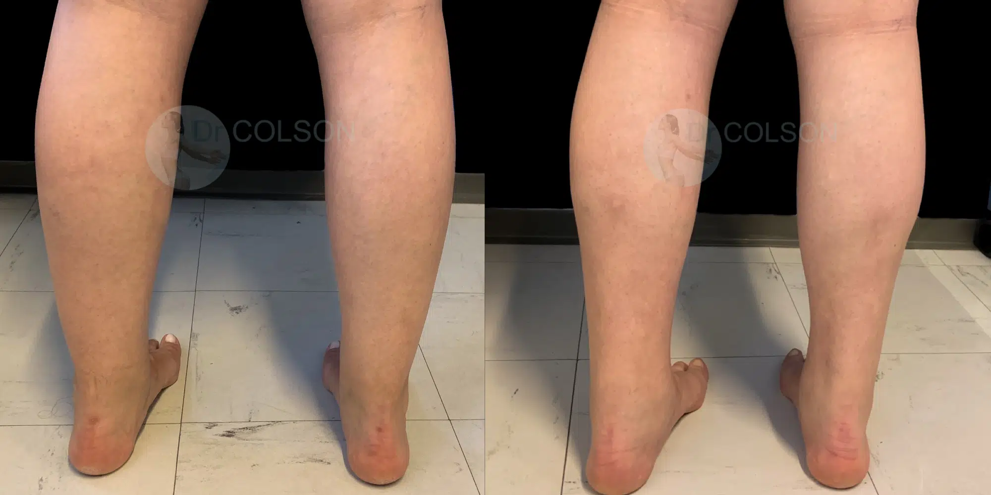 Dr Colson - Chirurgie silhouette - Liposuccion Mollet Dos