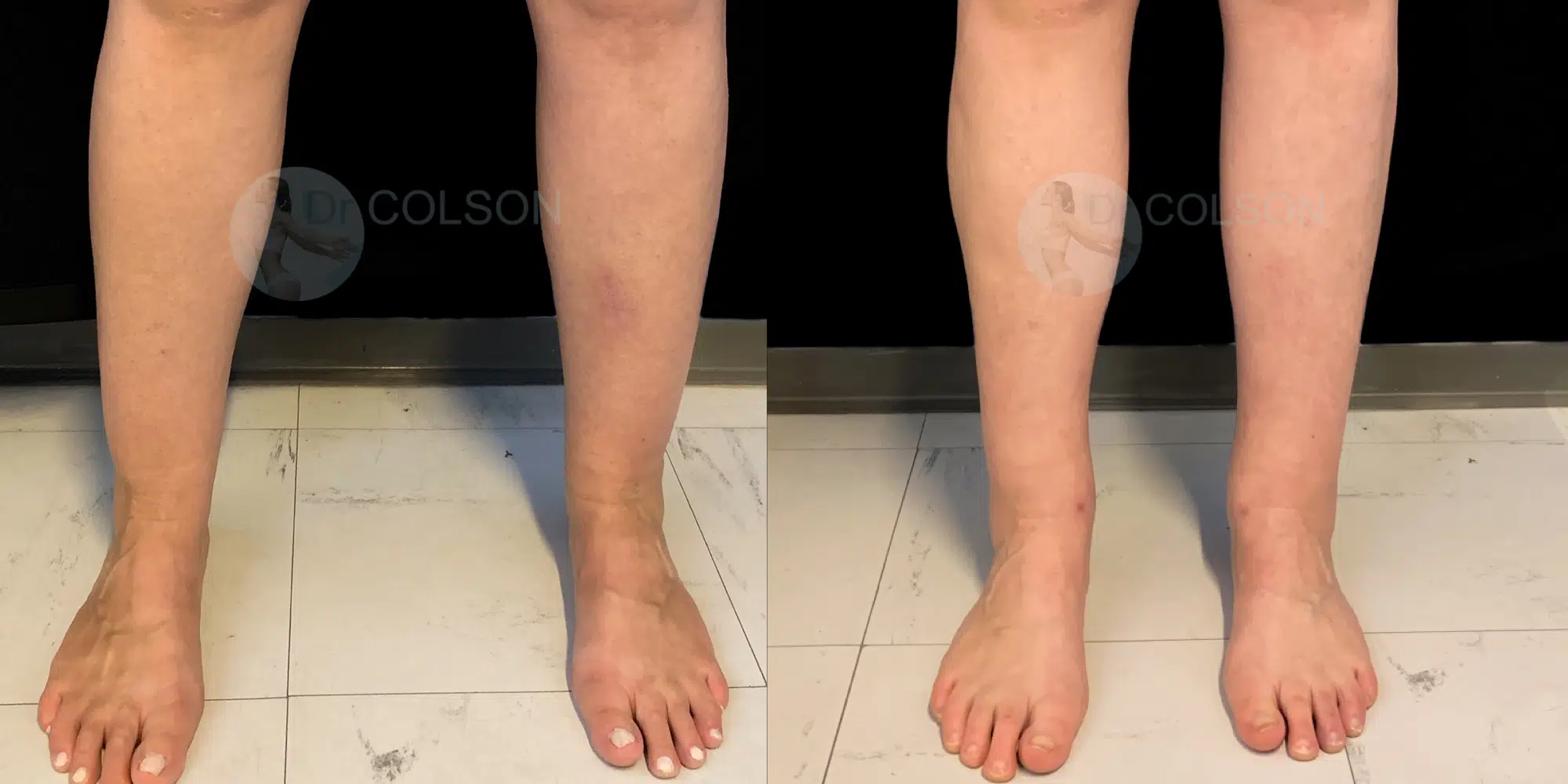 Dr Colson - Chirurgie silhouette - Liposuccion Mollet Face