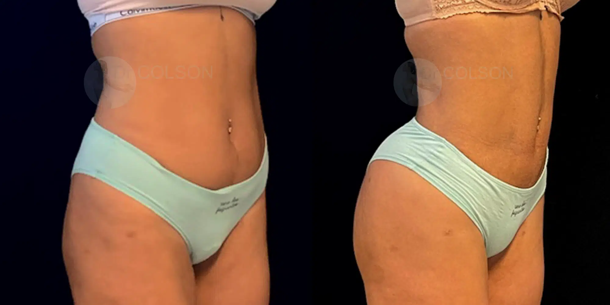 Dr Colson - Chirurgie silhouette - Liposuccion Ventre Trois Quart 2