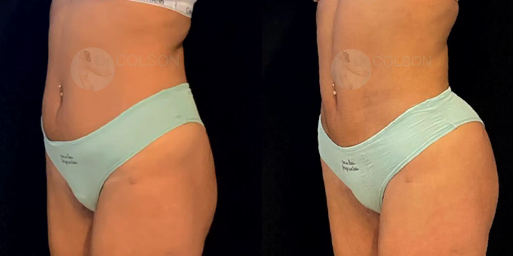 Dr Colson - Chirurgie silhouette - Liposuccion Ventre Trois Quart