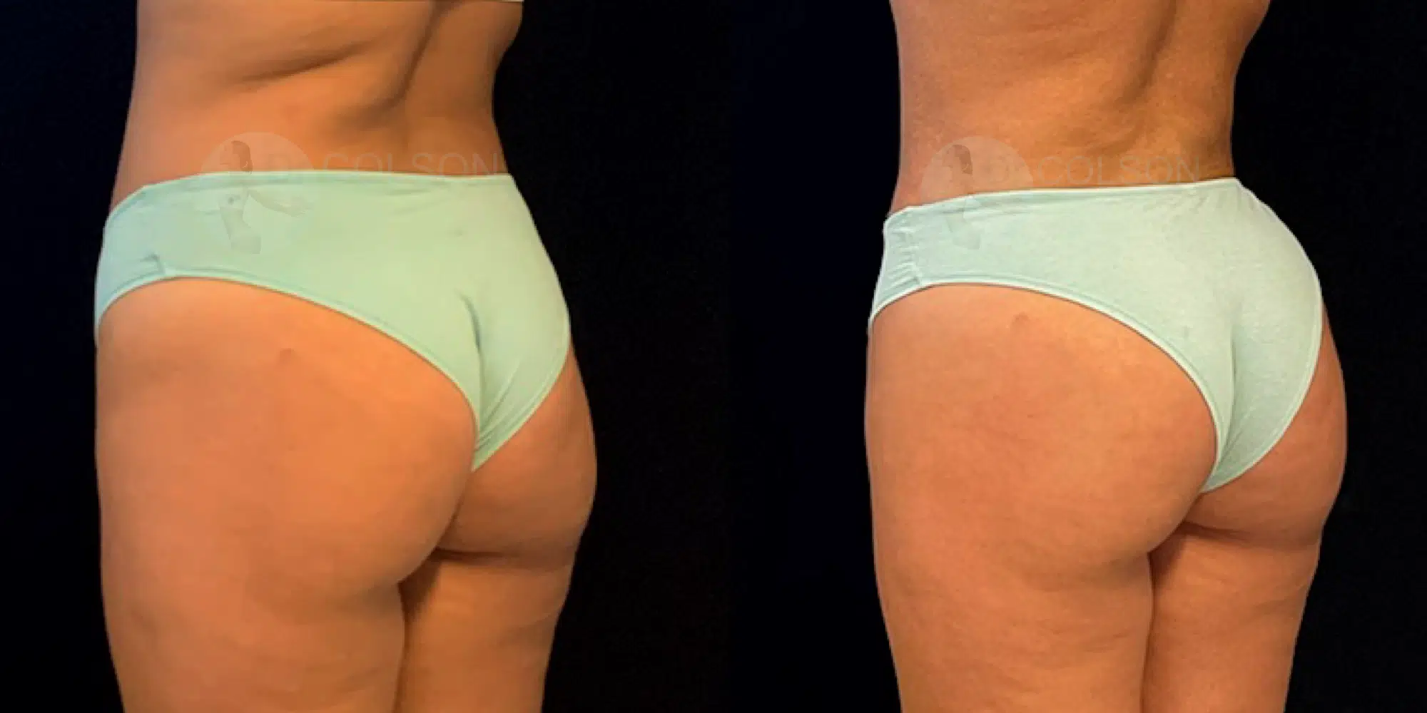 Dr Colson - Chirurgie silhouette - Liposuction Ventre Trois Quart Dos