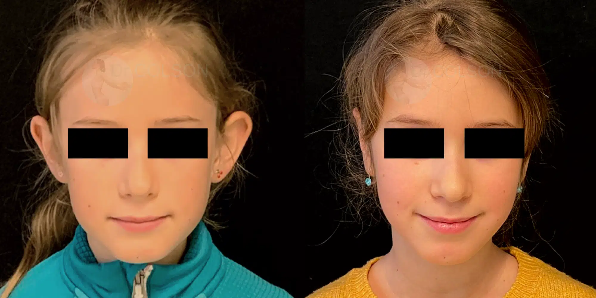 Dr Colson - Chirurgie visage - Otoplastie Face