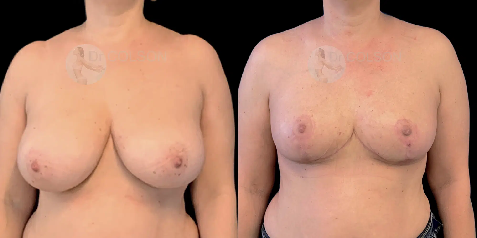 Dr Colson - Chirurgie sein - Reduction Mammaire Face