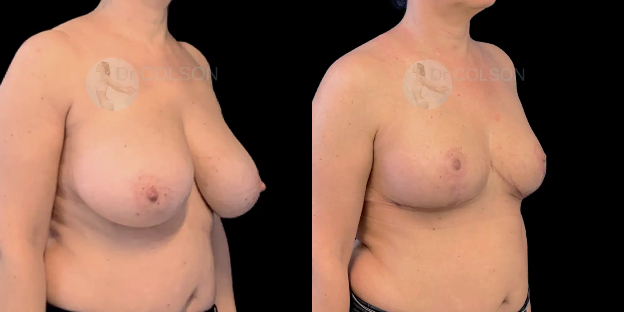 Dr Colson - Chirurgie sein - Reduction Mammaire Trois Quart